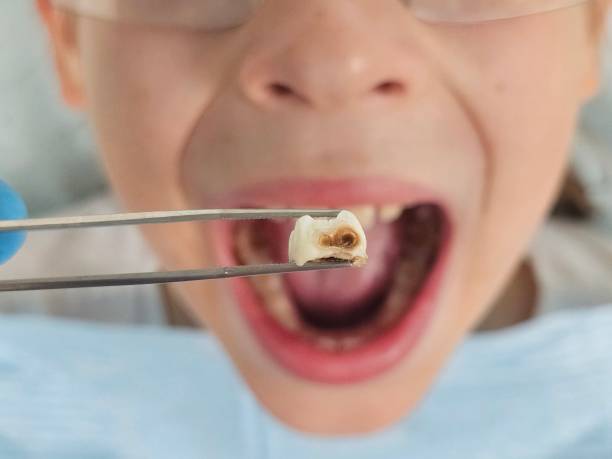 Best Emergency Dentist for Knocked-Out Tooth in Bruceton, TN